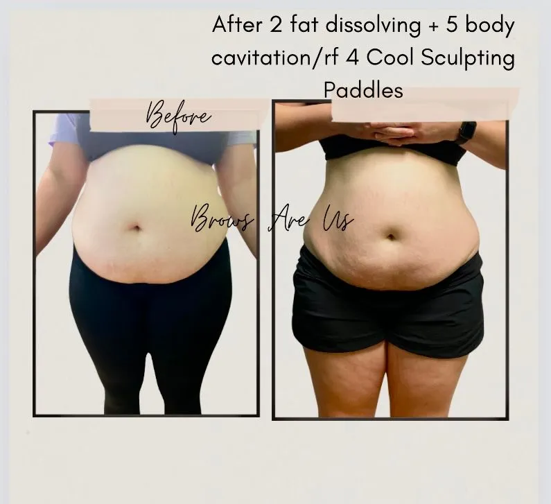 Before-and-after body-contouring example with the supplied treatment note.