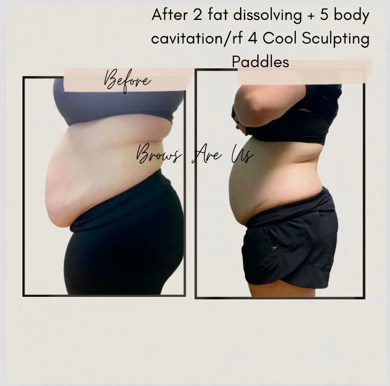 Side-view before-and-after body-contouring example with the supplied treatment note.